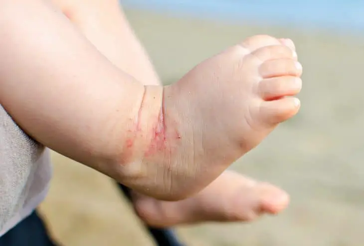 toddler foot peeling